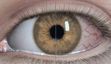 Sauerstoffversorgung bei Kontaktlinsen